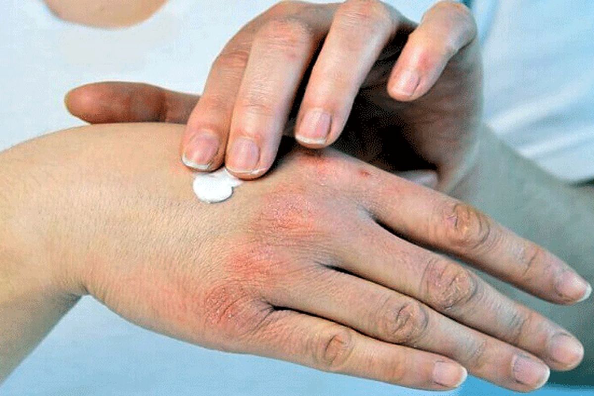 راهکار های خانگی برای جلوگیری از خشکی پوست دست در پاییز